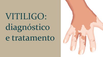 VITILIGO: diagnóstico e tratamento