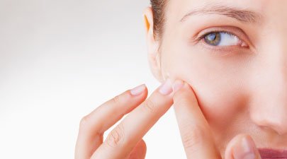 Soluções imbatíveis para tratar acne de verão